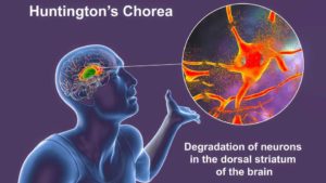 Les scientifiques sont sur le point de créer un médicament pour prévenir la maladie de Huntington